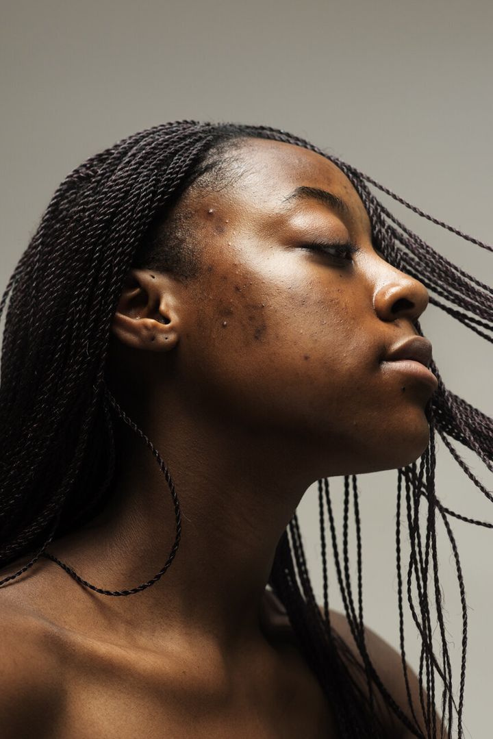Sophie Harris-Taylor created a photography series that highlights faces with skin conditions such as acne, rosacea and eczema