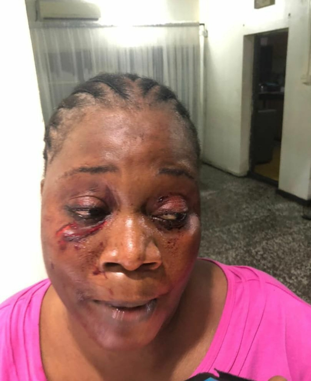 Woman allegedly disfigures her neighbour's face for reporting her actions in the compound to their lawyer