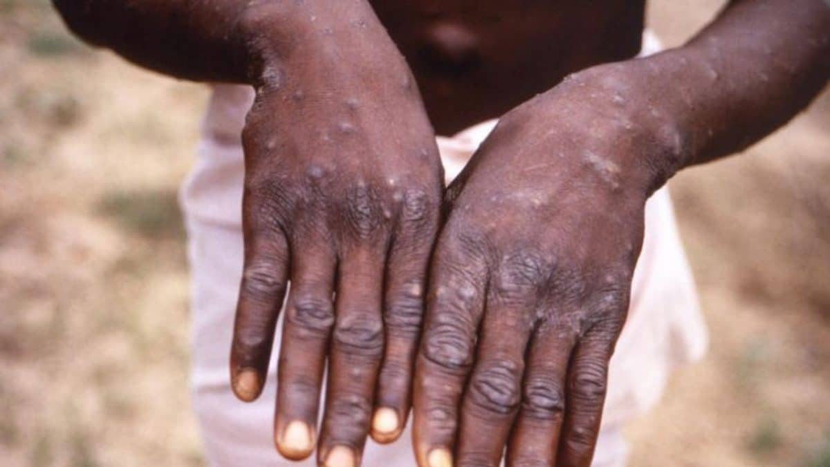 ncdc confirms 15 cases of monkeypox in nigeria