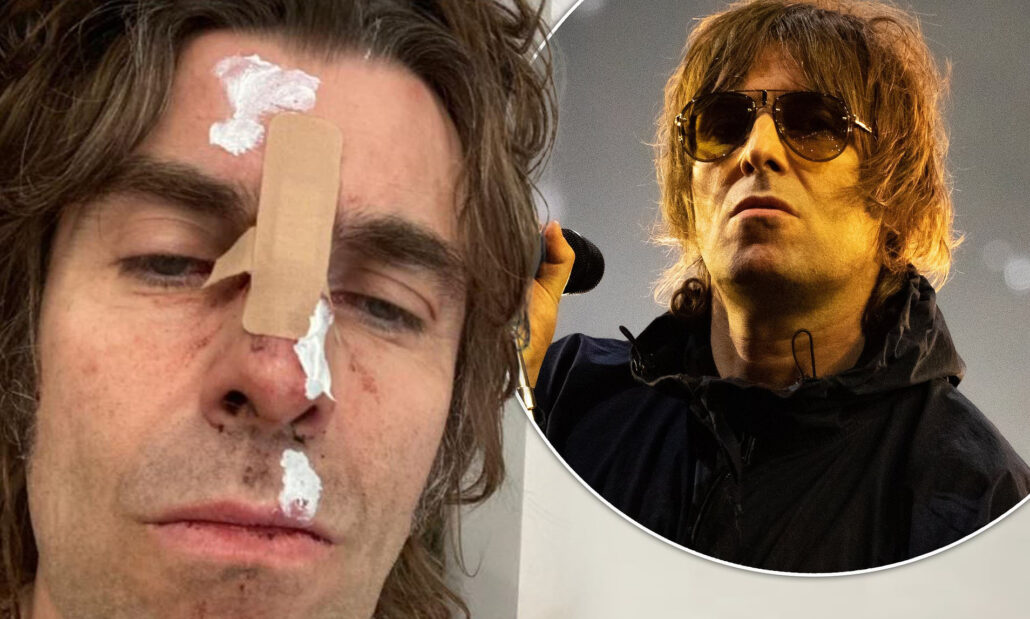Singer Liam Gallagher suffers face injury after falling off a helicopter 