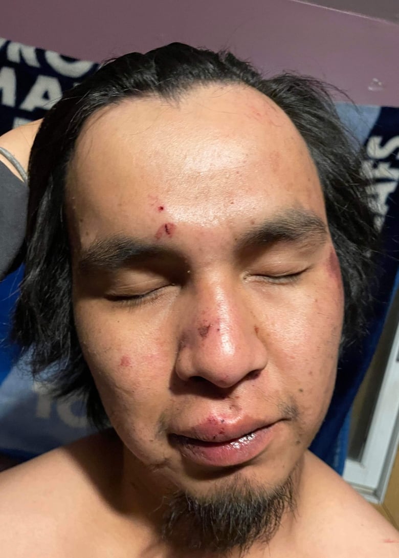 James Masakeyash, 24, with injuries on his face following an incident involving a Nishnawbe Aski Police Service officer now under investigation by the Ontario Provincial Police.
