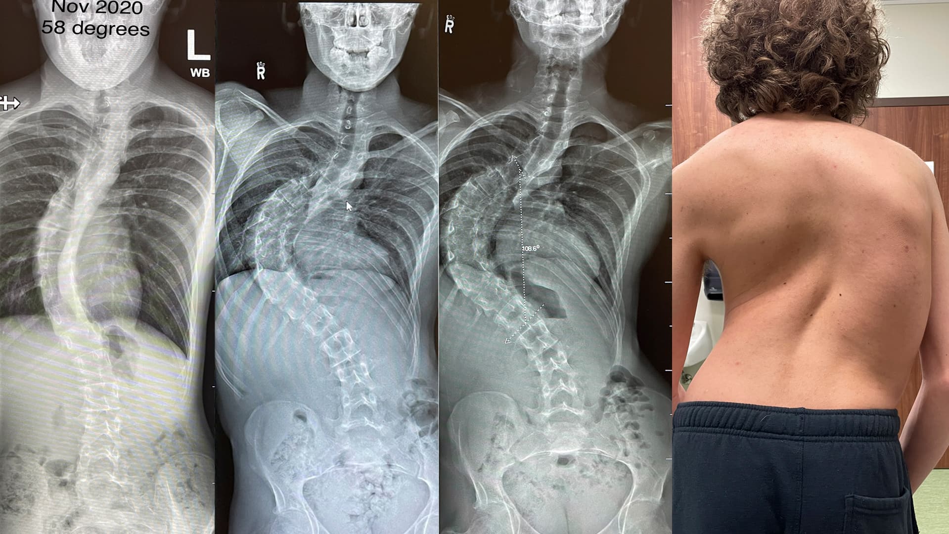 b c teenager waited almost 2 years for scoliosis surgery 1