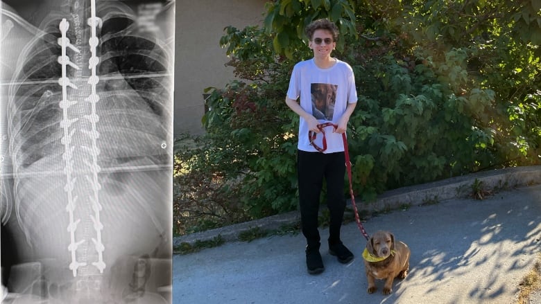 b c teenager waited almost 2 years for scoliosis surgery 4