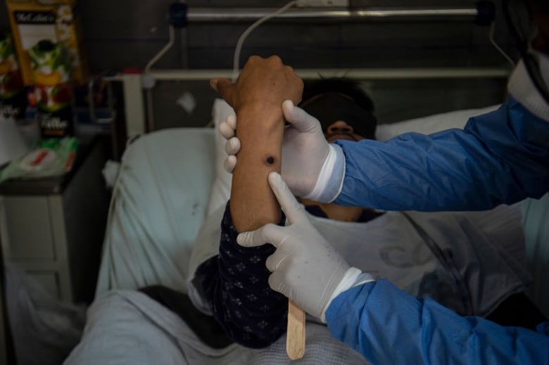 A doctor's gloved hand holds up a patient's arm showing a large sore, as patient lays in hospital bed.