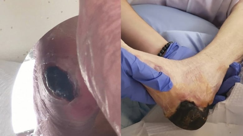 two photos of the pressure wound on the heel of Helena Mullin are shown side-by-side, showing the wound as it grew to cover her heel 