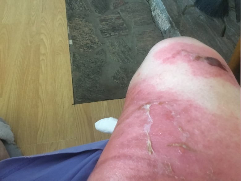 Skin on a woman's leg is peeling and a scab has formed as a burn injury heals.