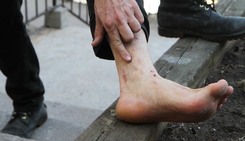A man's foot with bites on it