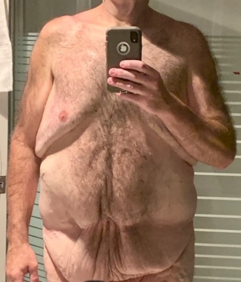 Front view of a shirtless man taking a photo of himself, showing low-hanging folds of skin in the lower abdomen. 