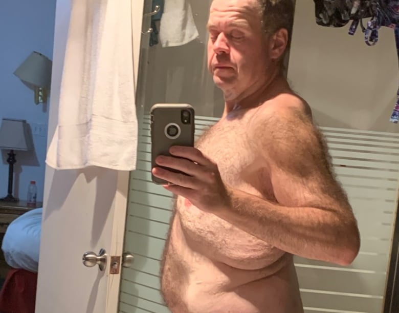 A man takes a selfie in front of a bathroom mirror to show folds of loose skin after a significant weight loss. 