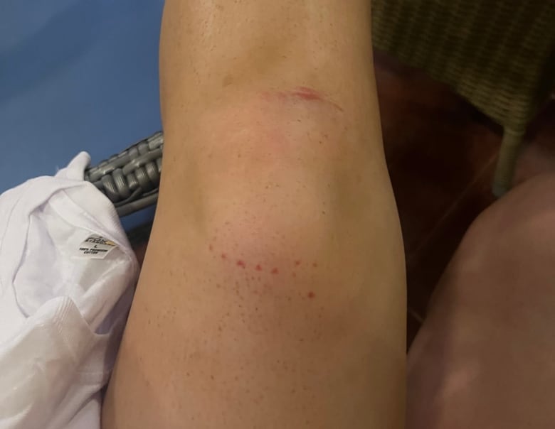 A woman shows a bruised knee.