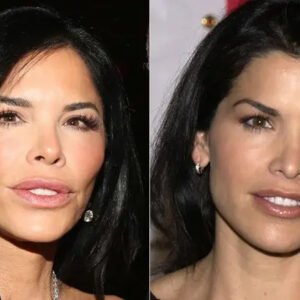Plastic Surgeon Tells Us The Secrets Behind Lauren Sanchez's Transformation