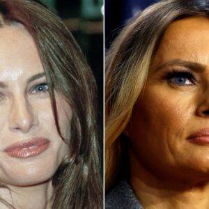 Side-By-Side Pics Of Melania Trump Highlight How Chiseled Her Face Has Become