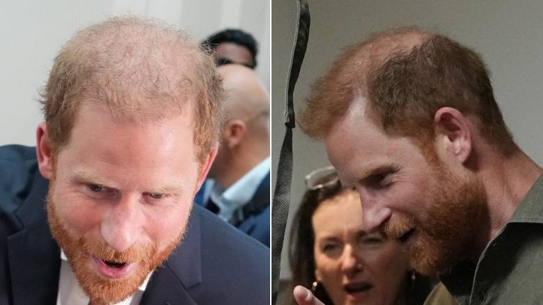 Prince Harry's Wicked Bald Patch Finds No Place To Hide In Australia As Cameras Capture Every Angle